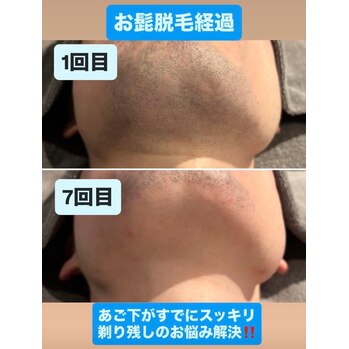 kyua人気ナンバーワン！髭脱毛